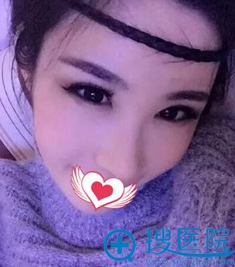 华韩整形自体脂肪填充全脸+自体脂肪隆鼻术后第62天效果图 华韩整形自体脂肪填充全脸+自体脂肪隆鼻术后第62天效果图