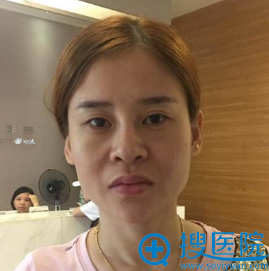 我在杭州格莱美整形医院花5万元找金凤茹做了面部线雕埋线提升