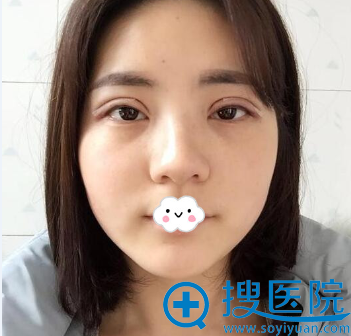 担心埋线保持时间短到<!--<i data=20240710 data-id=12206></i>-->蒋翔峰处做持久性切开双眼皮了 担心埋线保持时间短到<!--<i data=20240710 data-id=12206></i>-->蒋翔峰处做持久性切开双眼皮了