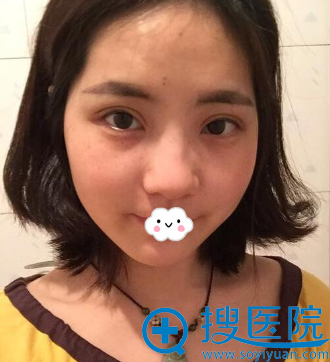 在<!--<i data=20240710 data-id=12206></i>-->蒋翔峰处割双眼皮术后18天效果 在<!--<i data=20240710 data-id=12206></i>-->蒋翔峰处割双眼皮术后18天效果