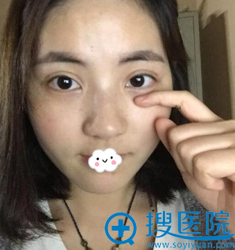 <!--<i data=20240710 data-id=12206></i>-->蒋翔峰韩式双眼皮真人案例效果图 <!--<i data=20240710 data-id=12206></i>-->蒋翔峰韩式双眼皮真人案例效果图
