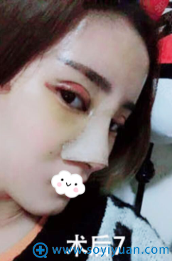 <!--<i data=20240710 data-id=9418></i>-->割双眼皮+隆鼻整形术后7天恢复效果图 <!--<i data=20240710 data-id=9418></i>-->割双眼皮+隆鼻整形术后7天恢复效果图