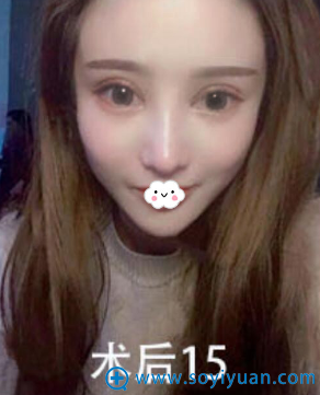 <!--<i data=20240710 data-id=9418></i>-->割双眼皮+隆鼻整形15天真人案例 <!--<i data=20240710 data-id=9418></i>-->割双眼皮+隆鼻整形15天真人案例