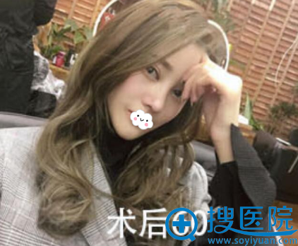 <!--<i data=20240710 data-id=9418></i>-->切开双眼皮+隆鼻60天真人案例效果图 <!--<i data=20240710 data-id=9418></i>-->切开双眼皮+隆鼻60天真人案例效果图