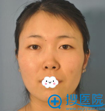 我在福州美莱华美免费招募脱颖,周珃韩式双眼皮+隆鼻综合整形图