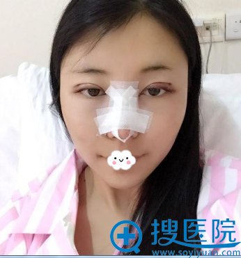<!--<i data=20240710 data-id=14690></i>-->华美周珃双眼皮+隆鼻术后效果图 <!--<i data=20240710 data-id=14690></i>-->华美周珃双眼皮+隆鼻术后效果图