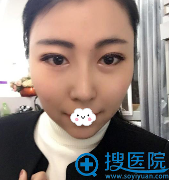 <!--<i data=20240710 data-id=14690></i>-->华美双眼皮+隆鼻效果怎么样?周珃真人案例术后照片 <!--<i data=20240710 data-id=14690></i>-->华美双眼皮+隆鼻效果怎么样?周珃真人案例术后照片