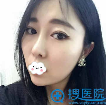 对比福州海峡后到<!--<i data=20240710 data-id=14690></i>-->华美割双眼皮+隆鼻综合整形案例 对比福州海峡后到<!--<i data=20240710 data-id=14690></i>-->华美割双眼皮+隆鼻综合整形案例