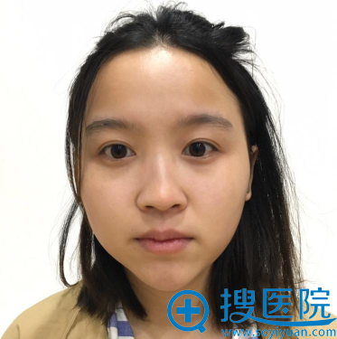 分享我找成都蜀尚蓉雅陈建华做鼻综合隆鼻和歪鼻矫正的亲身经历