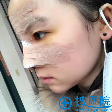 <!--<i data=20240710 data-id=14447></i>-->陈建华隆鼻手术第五天 <!--<i data=20240710 data-id=14447></i>-->陈建华隆鼻手术第五天