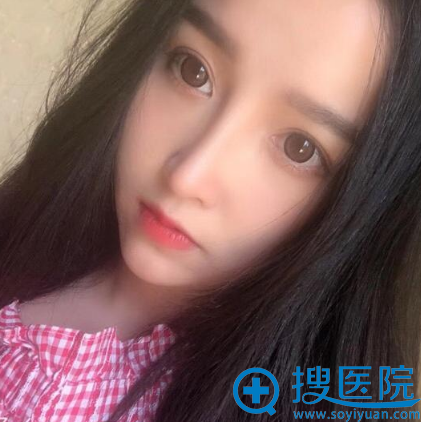 成都蜀尚蓉陈建华隆鼻案例手术半年图片 成都蜀尚蓉陈建华隆鼻案例手术半年图片