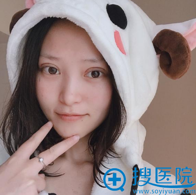 在<!--<i data=20240710 data-id=14447></i>-->做双眼皮第二天 在<!--<i data=20240710 data-id=14447></i>-->做双眼皮第二天