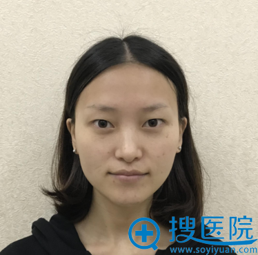 在<!--<i data=20240710 data-id=14447></i>-->做双眼皮手术前 在<!--<i data=20240710 data-id=14447></i>-->做双眼皮手术前