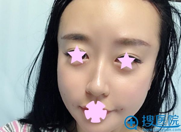 全脸脂肪填充天 全脸脂肪填充天