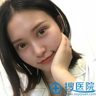 全切双眼皮术后15天 全切双眼皮术后15天