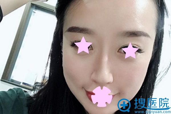 锡施尔美脂肪填充面部一个月的恢复效果 锡施尔美脂肪填充面部一个月的恢复效果