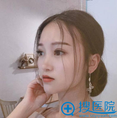 <!--<i data=20240710 data-id=14447></i>-->做的双眼皮一个月自拍 <!--<i data=20240710 data-id=14447></i>-->做的双眼皮一个月自拍