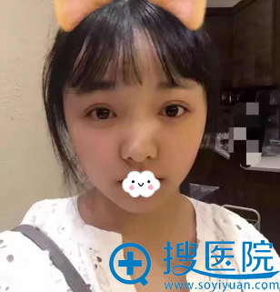 我的天鹅弧美鼻日记:重庆华美鼻综合整形术后恢复期真实图片