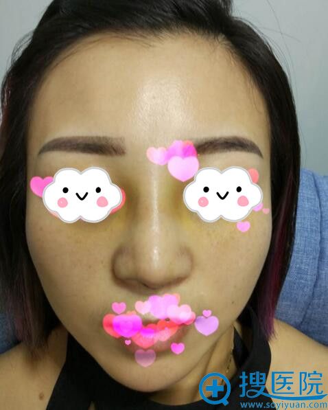 宁波北仑美仁潘杰硅胶假体隆鼻术后效果图 宁波北仑美仁潘杰硅胶假体隆鼻术后效果图