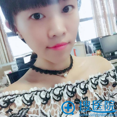 看了杭州连天美盛飞医生的案例后找姜鑫利做了全切双眼皮