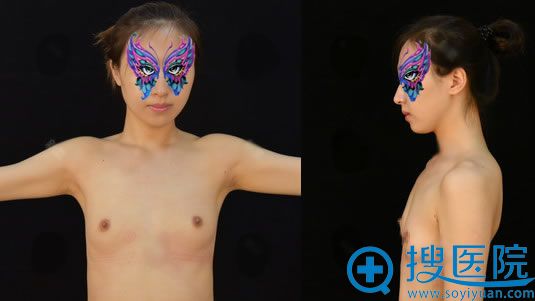 问闺蜜北京史三八和薇琳哪个好?推荐我找薇琳胡庆旭做假体隆胸