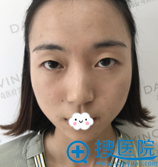 对比南充五星与<!--<i data=20240710 data-id=12042></i>-->案例效果图后让苟磊做了切开双眼皮 对比南充五星与<!--<i data=20240710 data-id=12042></i>-->案例效果图后让苟磊做了切开双眼皮
