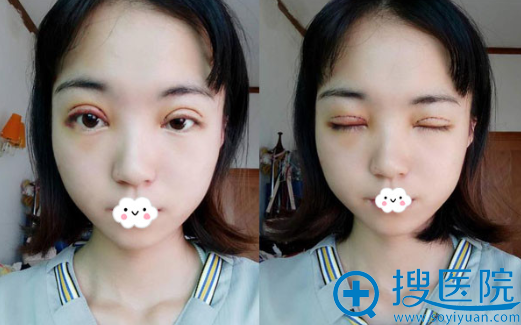 <!--<i data=20240710 data-id=12042></i>-->割双眼皮效果怎么样?苟磊切开双眼皮真人案例 <!--<i data=20240710 data-id=12042></i>-->割双眼皮效果怎么样?苟磊切开双眼皮真人案例