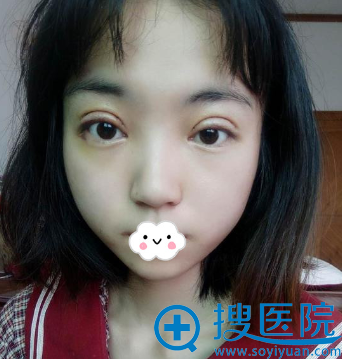 <!--<i data=20240710 data-id=12042></i>-->苟磊切开双眼皮效果好吗 <!--<i data=20240710 data-id=12042></i>-->苟磊切开双眼皮效果好吗