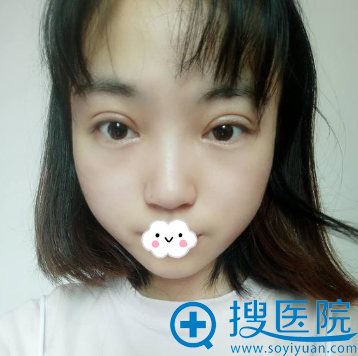 <!--<i data=20240710 data-id=12042></i>-->苟磊切开双眼皮术后15天真实效果图 <!--<i data=20240710 data-id=12042></i>-->苟磊切开双眼皮术后15天真实效果图