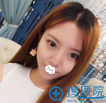 武汉米兰齐尚华假体隆鼻术后效果图 武汉米兰齐尚华假体隆鼻术后效果图