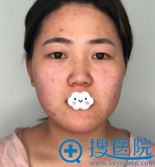 我在西安逆时光续锐处做复合隆鼻+眼综合整形靓出新高度