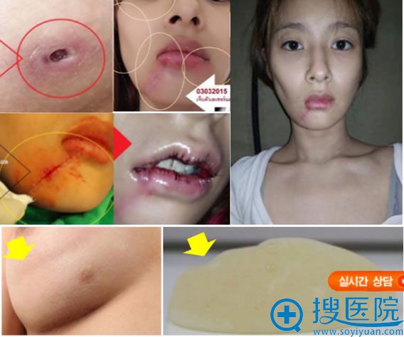 选择韩国faceline菲斯莱茵成功修复假体隆胸失败和下颌角不对称