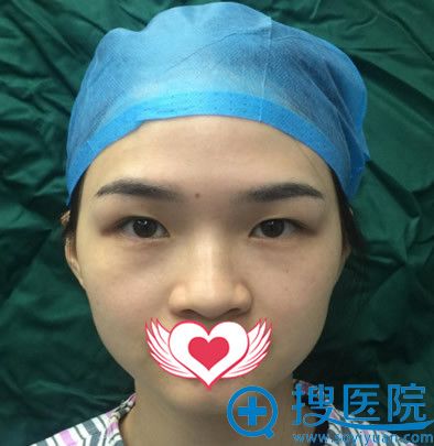 没有找<!--<i data=20240710 data-id=10744></i>-->周霖做全切双眼皮+开内眼角前样子 没有找<!--<i data=20240710 data-id=10744></i>-->周霖做全切双眼皮+开内眼角前样子