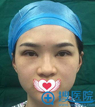 在<!--<i data=20240710 data-id=10744></i>-->割双眼皮加开内眼角即刻照片 在<!--<i data=20240710 data-id=10744></i>-->割双眼皮加开内眼角即刻照片