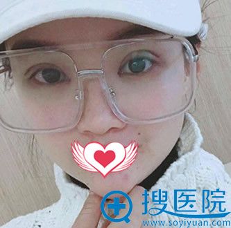 <!--<i data=20240710 data-id=10744></i>-->全切双眼皮+开内眼角术后第7天拆线后照片 <!--<i data=20240710 data-id=10744></i>-->全切双眼皮+开内眼角术后第7天拆线后照片