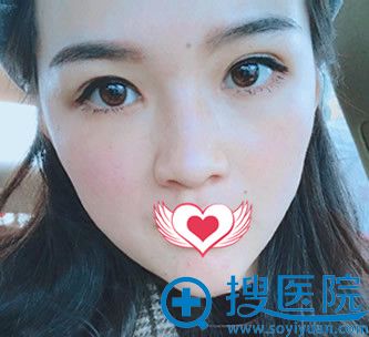 爱思特整形割双眼皮+开内眼角术后第9天效果图 爱思特整形割双眼皮+开内眼角术后第9天效果图