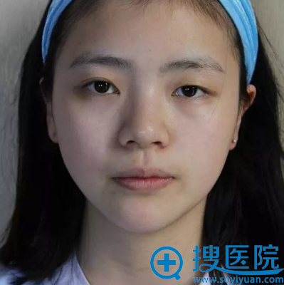 在贵阳美莱做双眼皮手术前 在贵阳美莱做双眼皮手术前