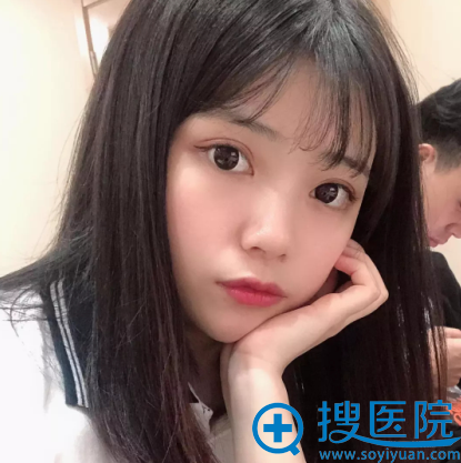 贵阳美莱罗曼做的双眼皮案例两个月效果图 贵阳美莱罗曼做的双眼皮案例两个月效果图
