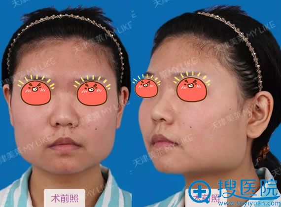 看我选择美莱VLINE双弧线改脸型来修正下颌角大方脸成就小V脸