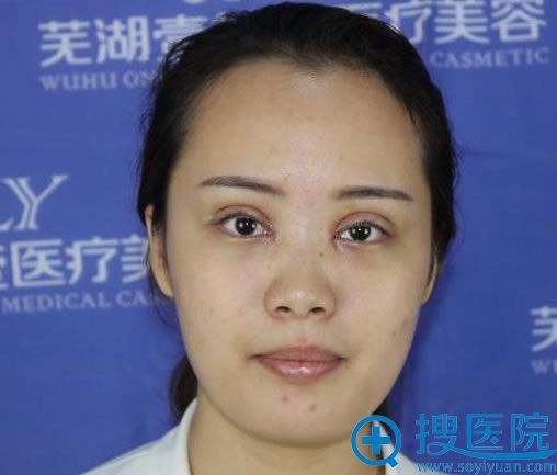 芜湖壹加壹做双眼皮修复3天效果 芜湖壹加壹做双眼皮修复3天效果
