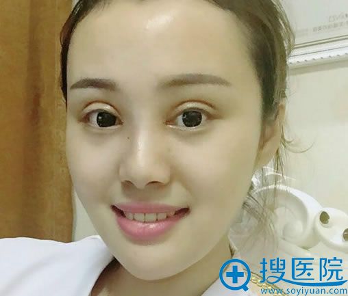 芜湖壹加壹双眼皮修复10天恢复照 芜湖壹加壹双眼皮修复10天恢复照