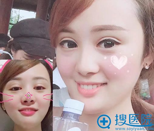 选择芜湖壹加壹做双眼皮修复30天后 选择芜湖壹加壹做双眼皮修复30天后