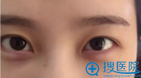 <!--<i data=20240710 data-id=9598></i>-->整形美容医院割双眼皮前 <!--<i data=20240710 data-id=9598></i>-->整形美容医院割双眼皮前