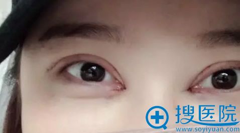 割双眼皮第三天 割双眼皮第三天