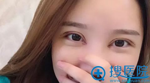 全切双眼皮第七天拆线前 全切双眼皮第七天拆线前