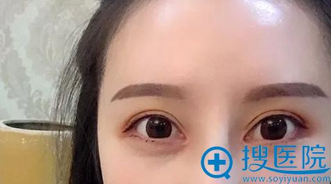 <!--<i data=20240710 data-id=9598></i>-->割双眼皮15天的恢复效果 <!--<i data=20240710 data-id=9598></i>-->割双眼皮15天的恢复效果