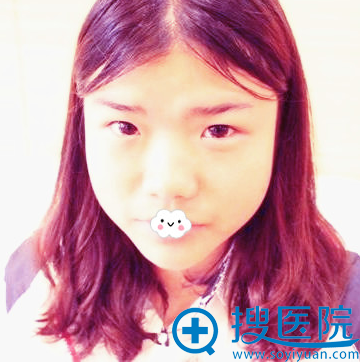 <!--<i data=20240710 data-id=8411></i>-->李宁江耳软骨复合隆鼻整形真人案例 <!--<i data=20240710 data-id=8411></i>-->李宁江耳软骨复合隆鼻整形真人案例