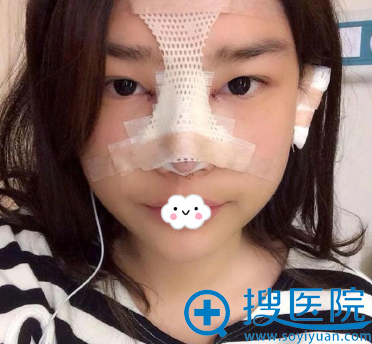 <!--<i data=20240710 data-id=8411></i>-->隆鼻怎么样?真人案例术后效果 <!--<i data=20240710 data-id=8411></i>-->隆鼻怎么样?真人案例术后效果