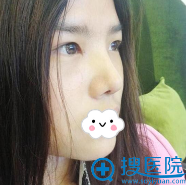 深圳隆鼻哪家好?<!--<i data=20240710 data-id=8411></i>-->自体软骨鼻综合案例 深圳隆鼻哪家好?<!--<i data=20240710 data-id=8411></i>-->自体软骨鼻综合案例