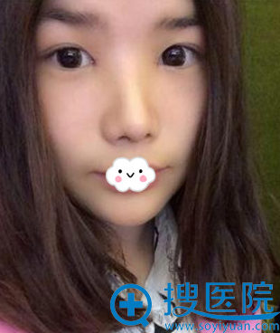 排斥假体到<!--<i data=20240710 data-id=8411></i>-->李宁江处做耳软骨复合隆鼻案例效果图 排斥假体到<!--<i data=20240710 data-id=8411></i>-->李宁江处做耳软骨复合隆鼻案例效果图